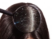 Перхоть: как она возникает на самом деле