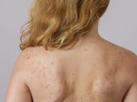 Откуда берутся прыщи на спине и как от них избавиться