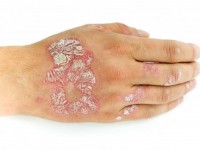 Диета Пегано для борьбы с псориазом: что это такое и может ли она помочь