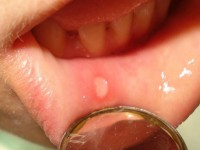 Как лечить стоматит
