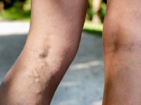 Откуда берётся варикоз и как его лечить