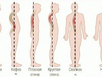 Осанка и боль в спине – что с этим делать?