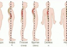 Осанка и боль в спине – что с этим делать?